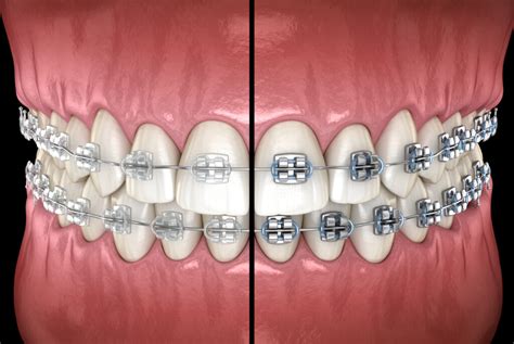 metal braces with clear brackets|difference between aligners and braces.